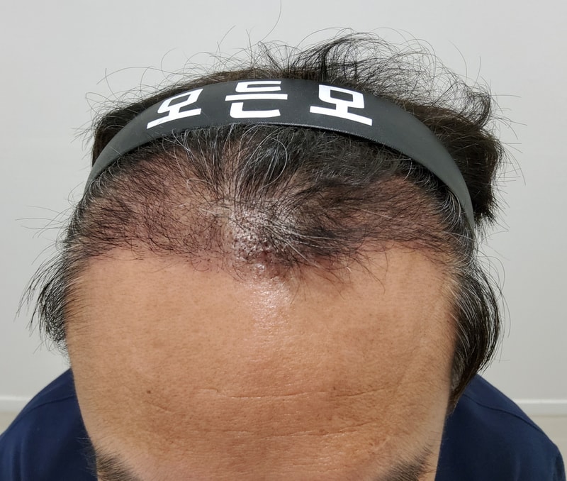 4. 수술후_3개월_1.jpg