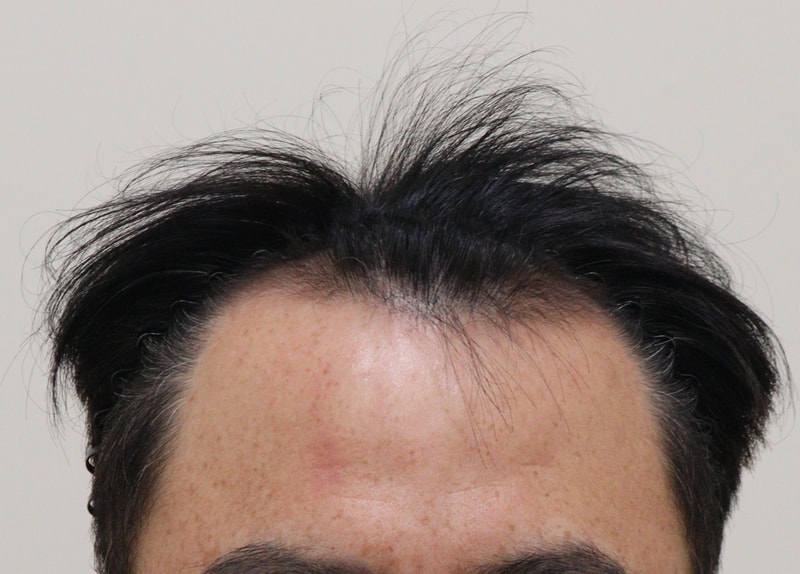 비절개로 모발이식 받고왔습니다^^