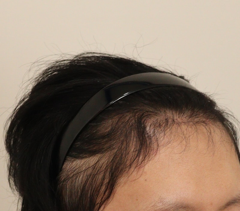 4. 수술후_6개월_2.JPG