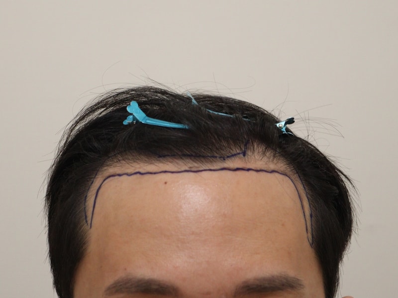 비절개 모발이식 3개월차 후기입니다