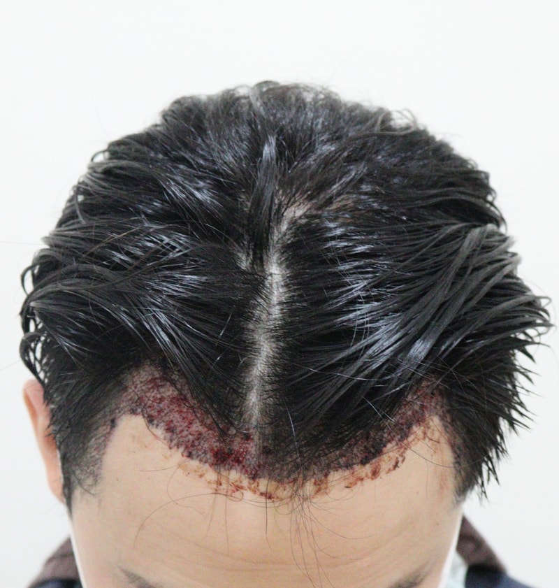 2. 수술후_1일.JPG