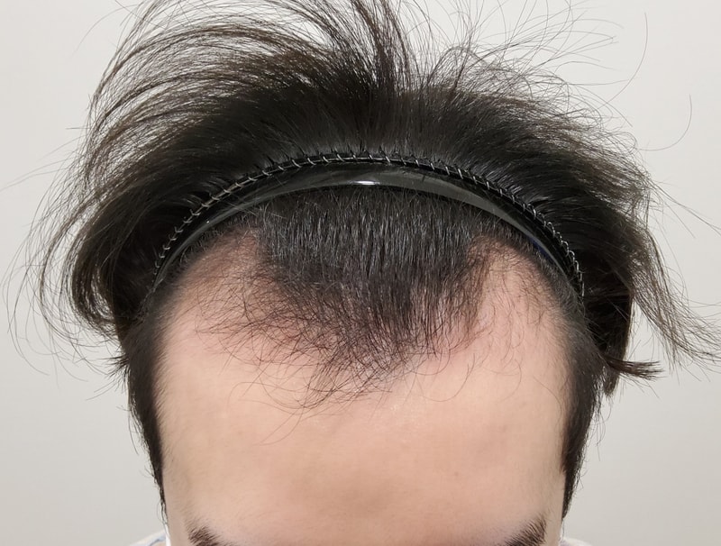 I've been happy with my hair transplant for 3 months!