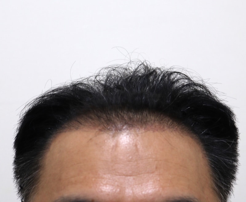 3. 수술후_3개월_1.JPG
