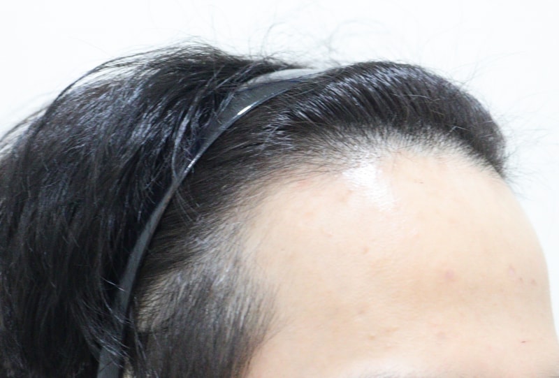 1. 수술전_2.JPG