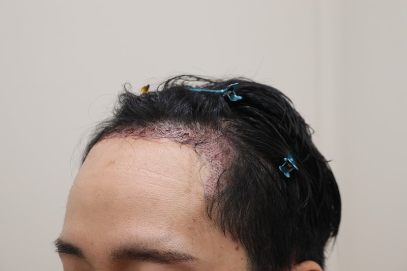 2. 수술후_1일_2.JPG