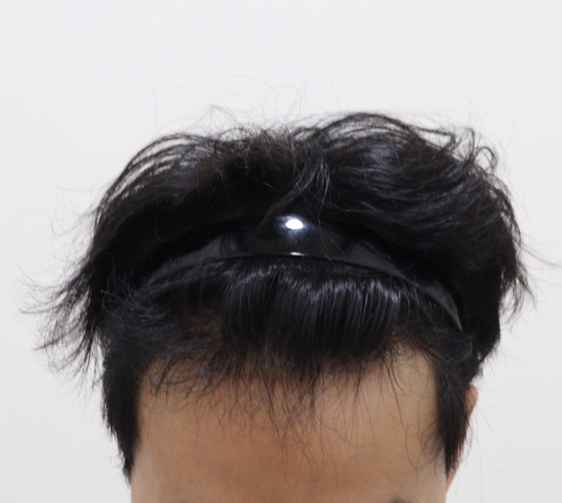 3. 수술후_6개월_1.JPG