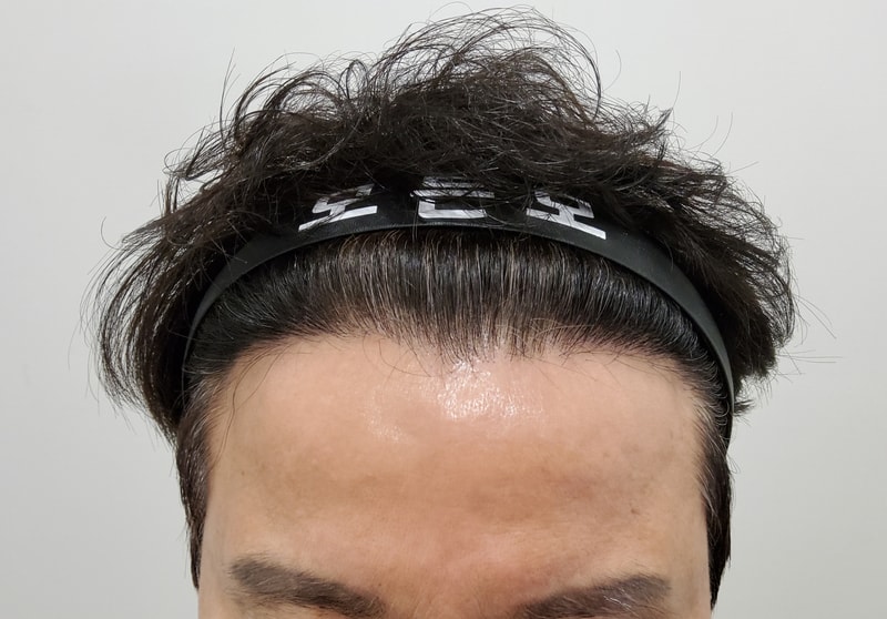 3. 수술후_6개월_1.jpg