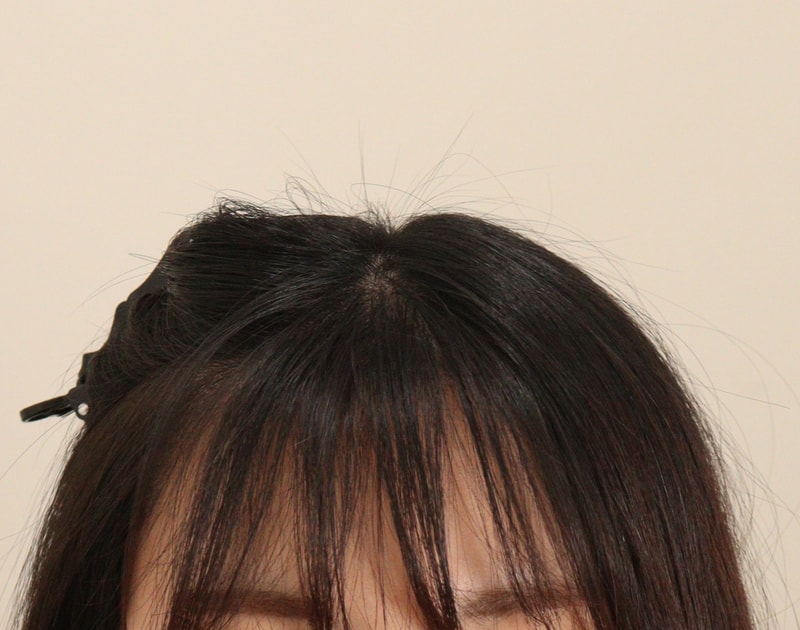 4. 수술후_6개월_2.JPG