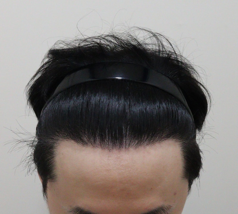 5. 수술후_1년_2.JPG