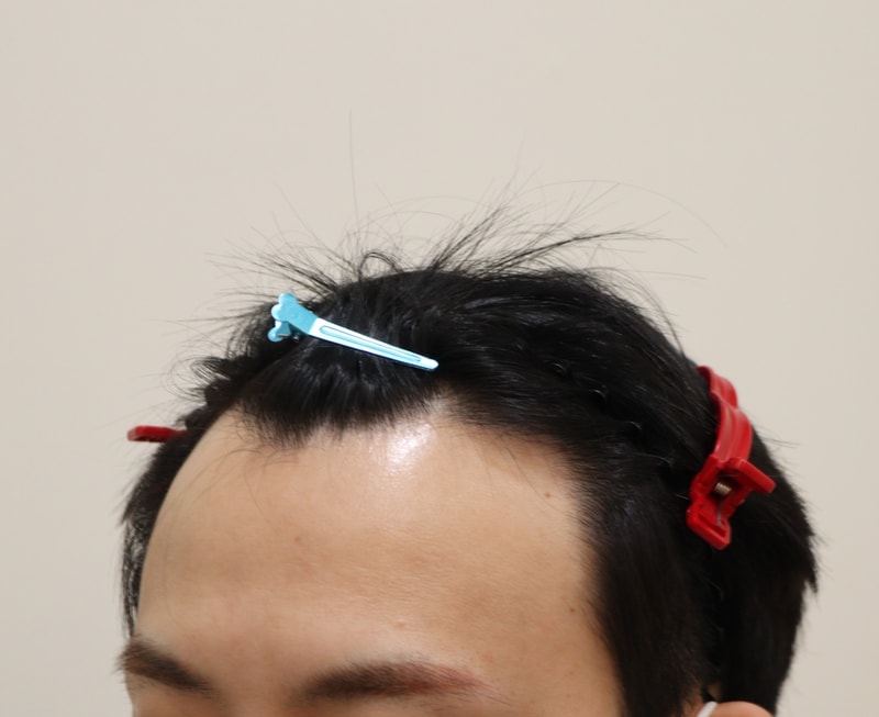 1. 수술전_2.JPG