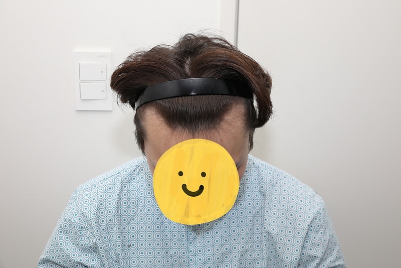 New Hair Seoul Branch Finally Has Been 12 Months of Hair Transplantation!