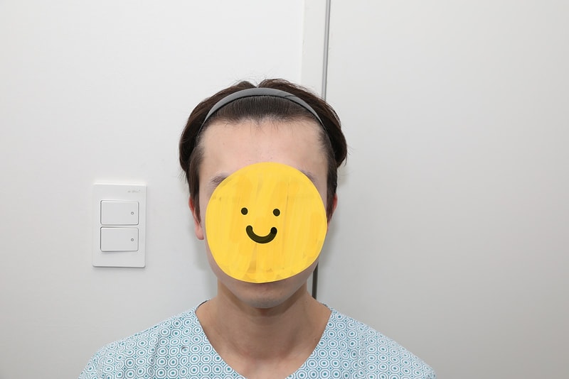 New Hair Seoul branch incision hair transplant 2300 hair follicles 9 months later!!!