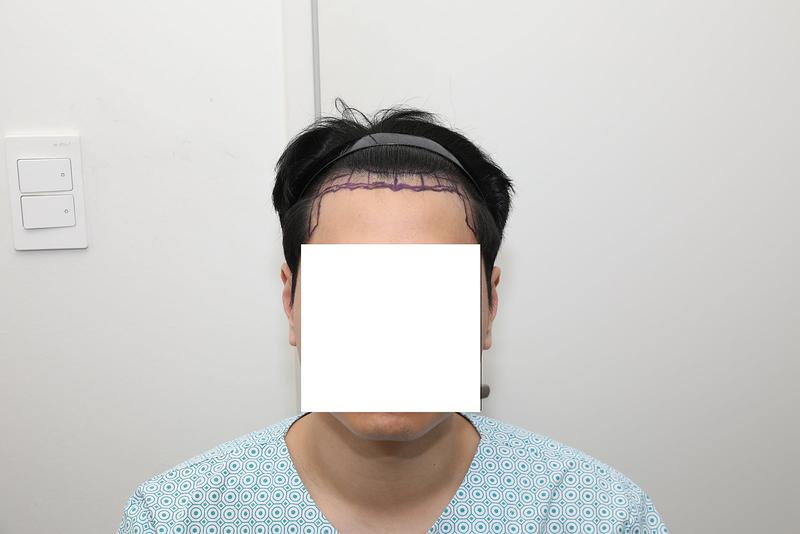 New Hair Non-Cutting 2300 Mo 6 Months Review