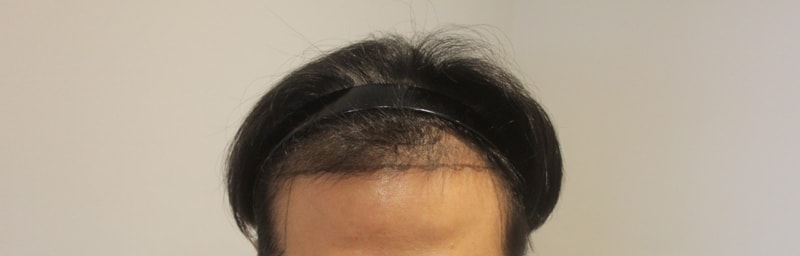 [NEW HAIR] 新发型 非接缝 1486 毛囊 6个月