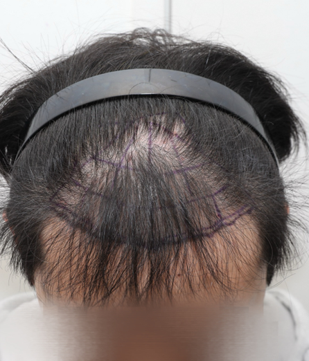 ニューヘアソウル店 毛髪移植7日目(1800毛包、3600毛)