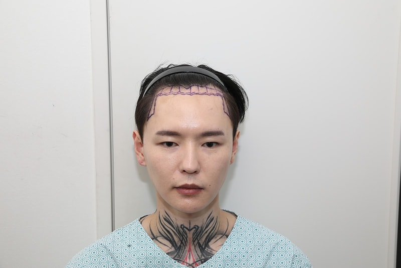 New Hair [Seoul Branch] 4,000 Mo incision 4 months later