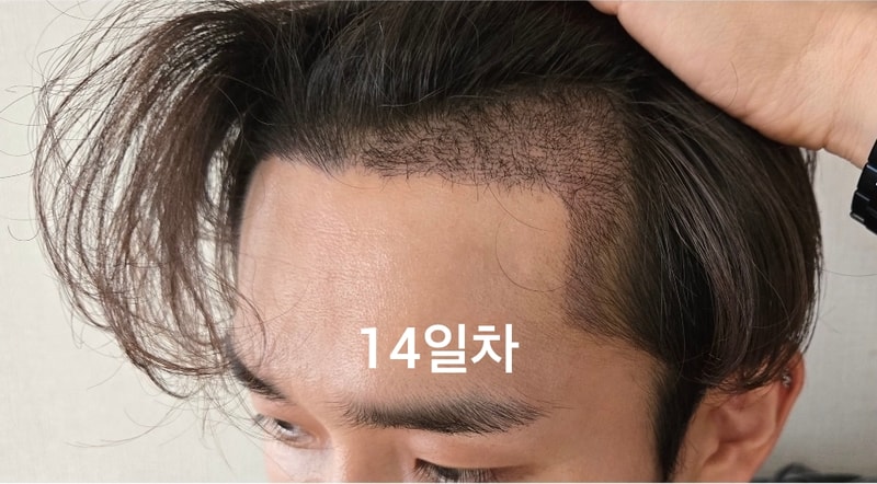 {더뷰티 성형외과 의원} 비절개 모발이식수술 후기