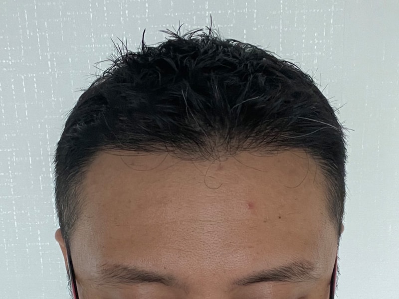 모발이식 수술후.jpg