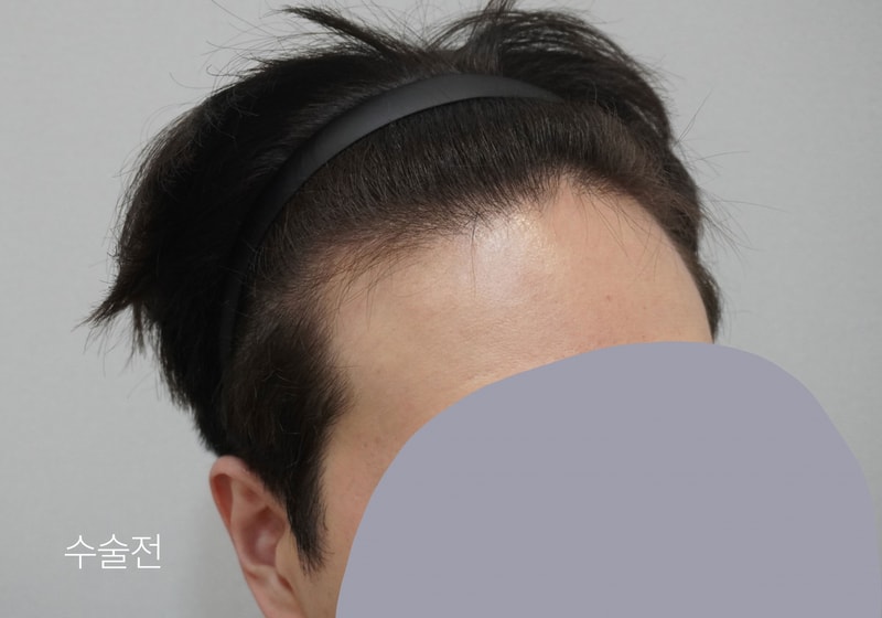 이주성_수술전1.jpg