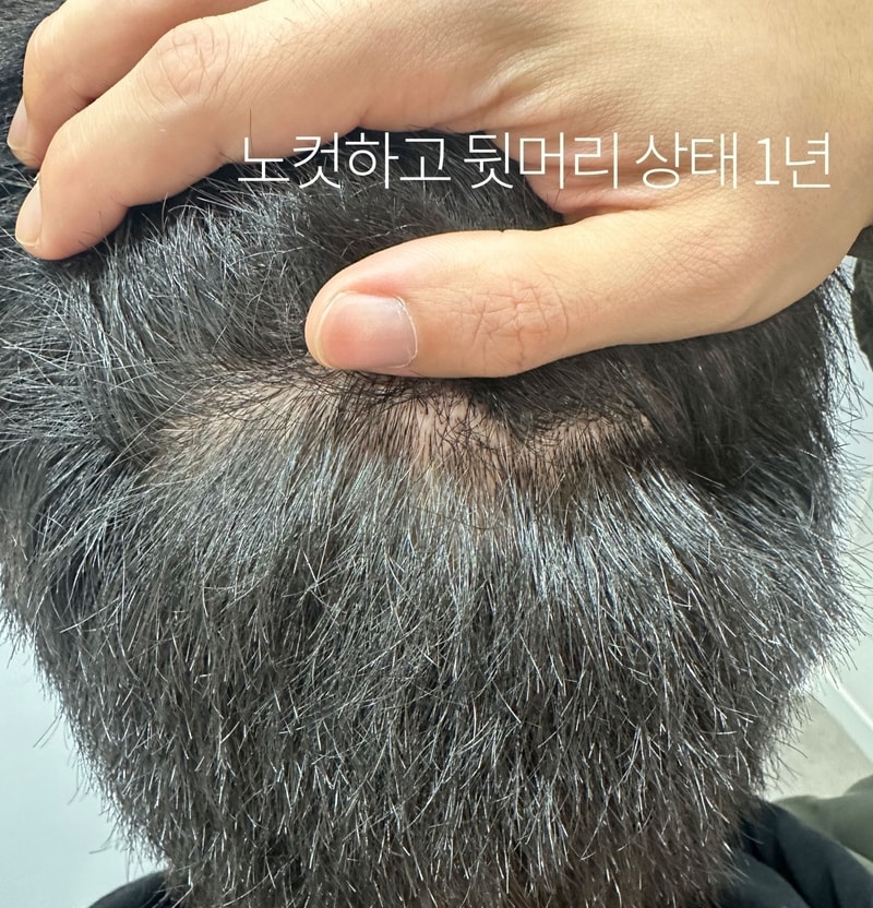 수술후_368D_후두부.jpg