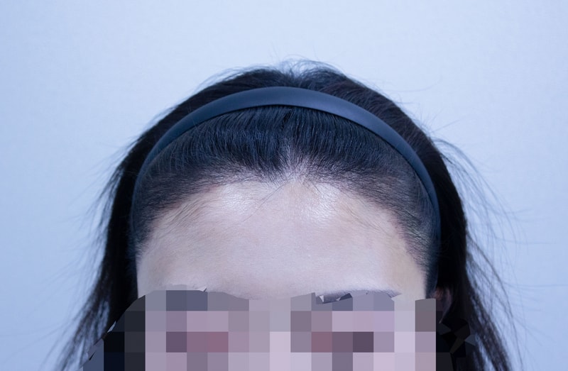 수술후_이지우_18D.jpg