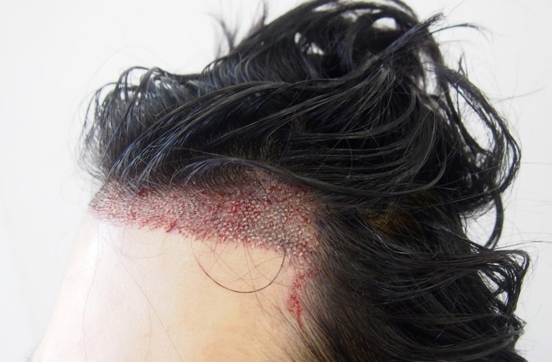 Surgery was performed at the parent castle. 1480 hair follicles