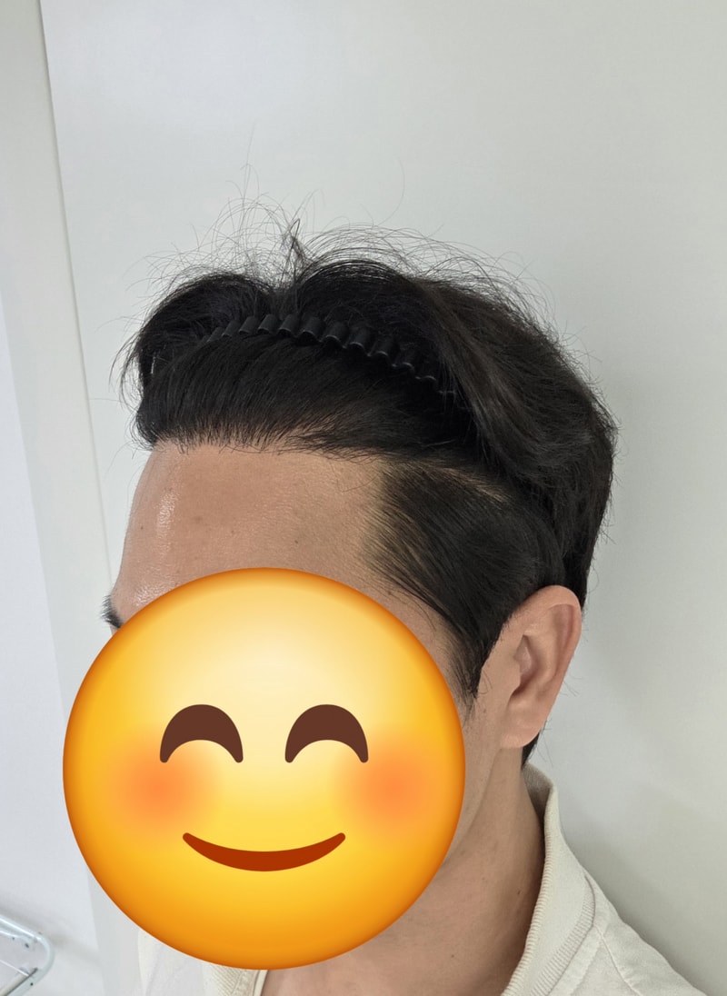 뉴헤어 m자 1500모낭 9개월 후기