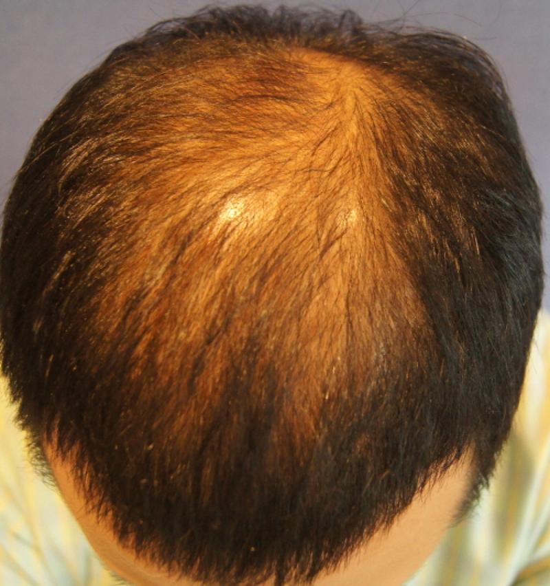 手术后的1600毛囊评价
