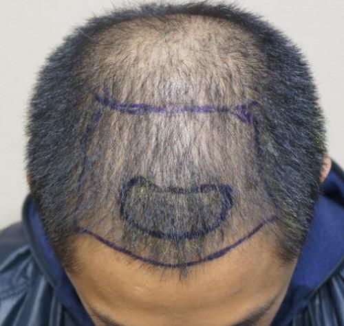 2000 Hair follicle front densification surgery 9 months ago