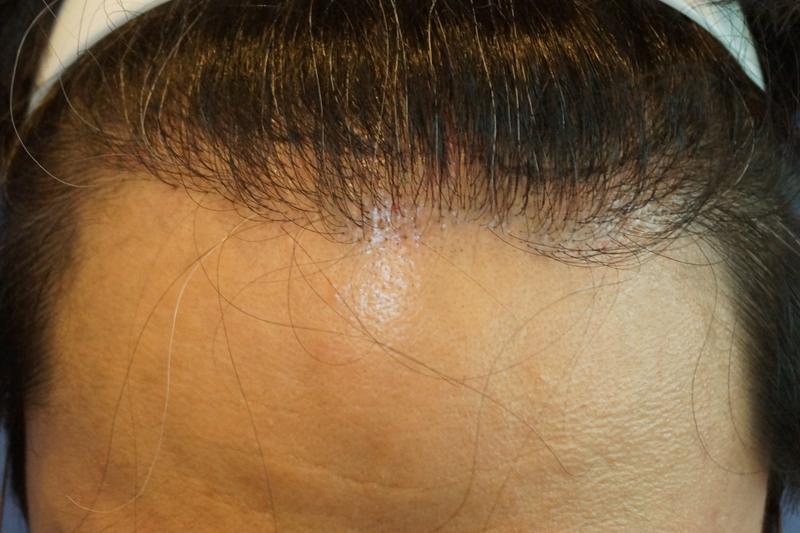非切開ヘアライン密度補強手術8ヵ月