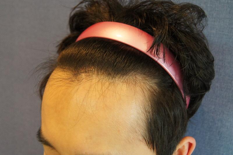 ヘアライン 無削髪 非切開 1200毛包 手術