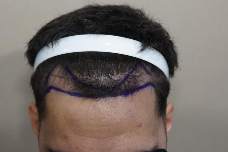 Motion 1100 Four months after hair transplantation for hair follicle non-cutter