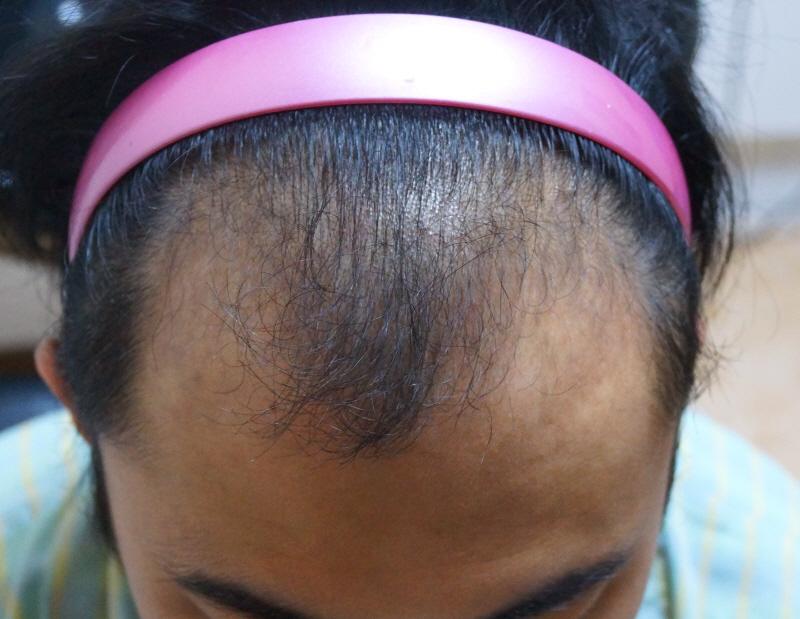 1600 Hair follicle non-cut hair transplantation for 7 months