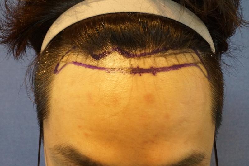 ヘアライン1000毛包手術4ヶ月後のレビュー