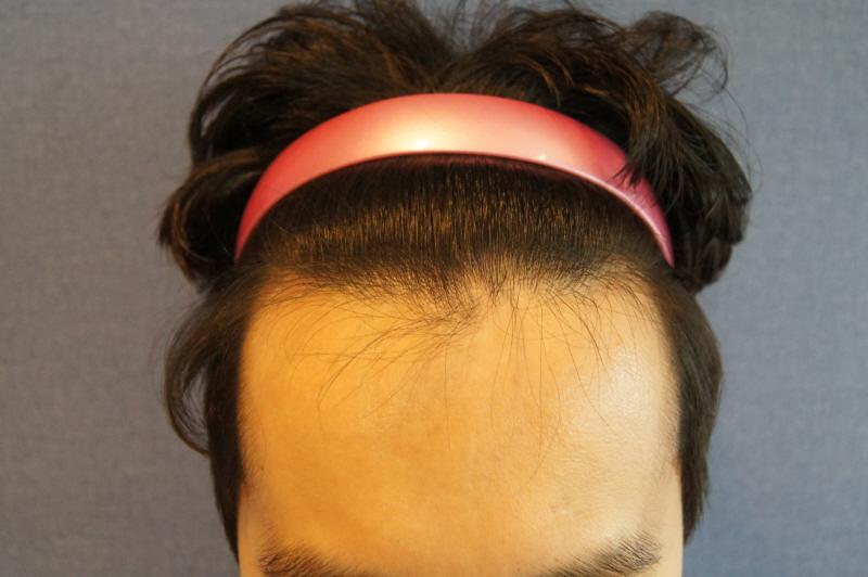 ヘアライン 無削髪 非切開 1200毛包 手術後 10ヵ月
