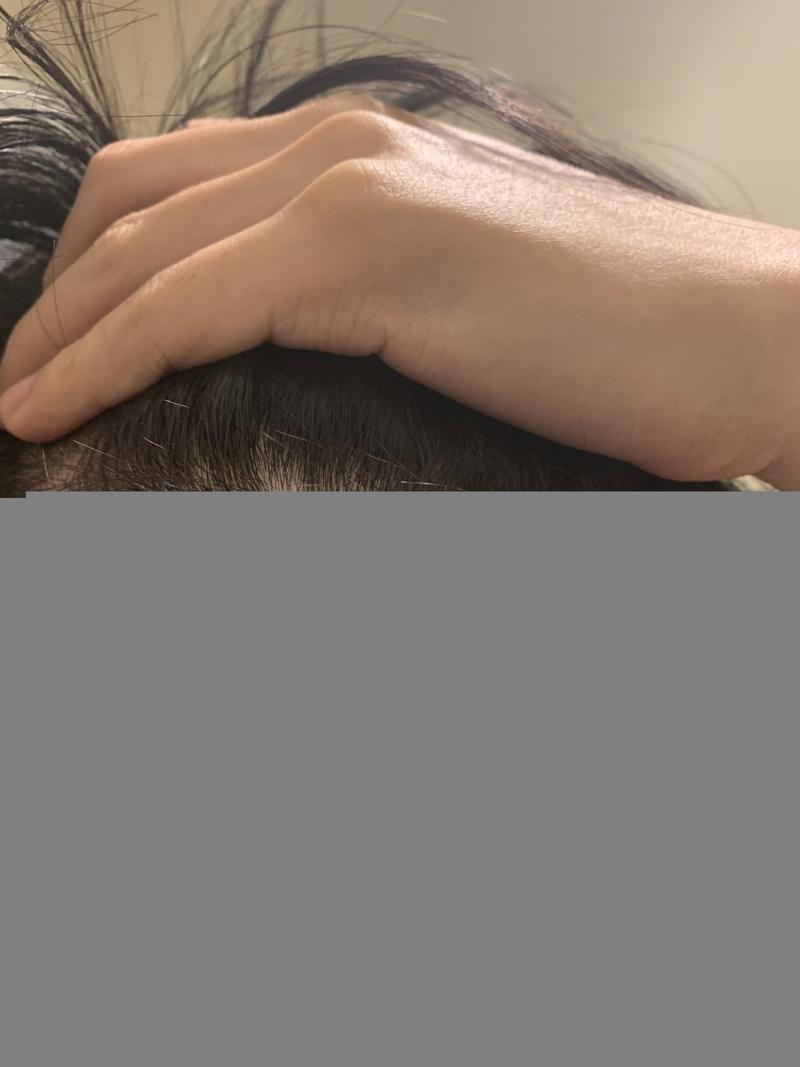 2000 Hair follicle non-excision 4 months