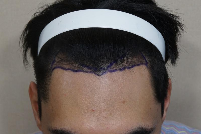 모션 비절개 1000모낭 부분삭발 수술 2일차입니다