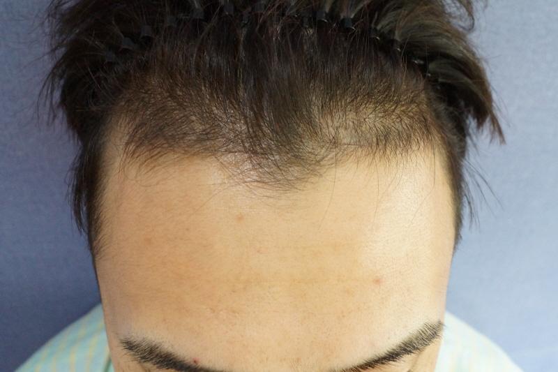1200모낭 헤어라인 수술 후 6개월입니다
