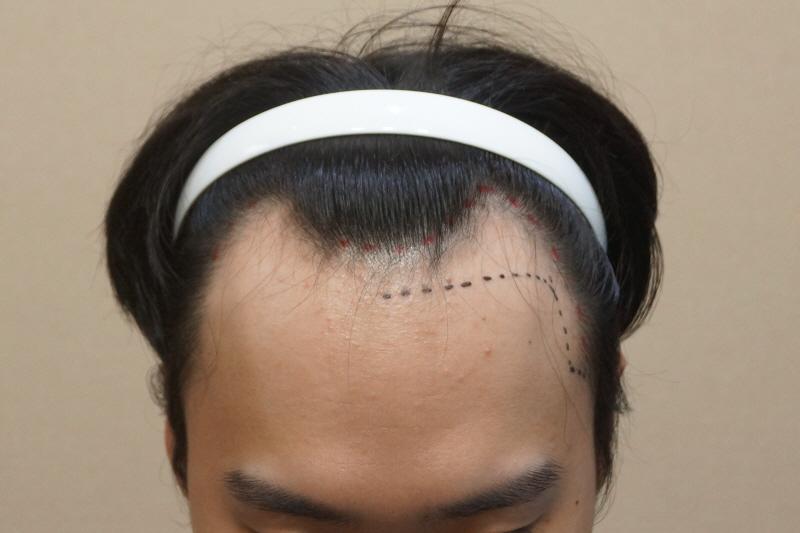 헤어라인 1600모낭 비절개 1년 3개월경과 후기