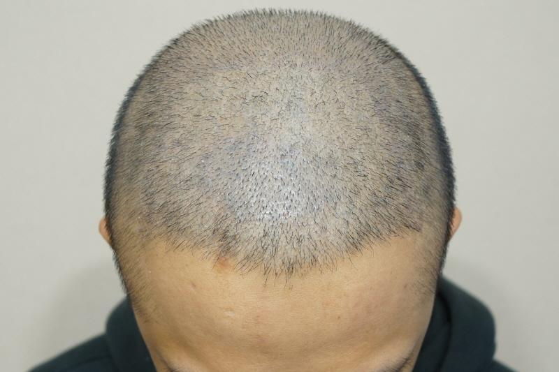 2000 Hair follicle crown density 2nd postoperative scab removal
