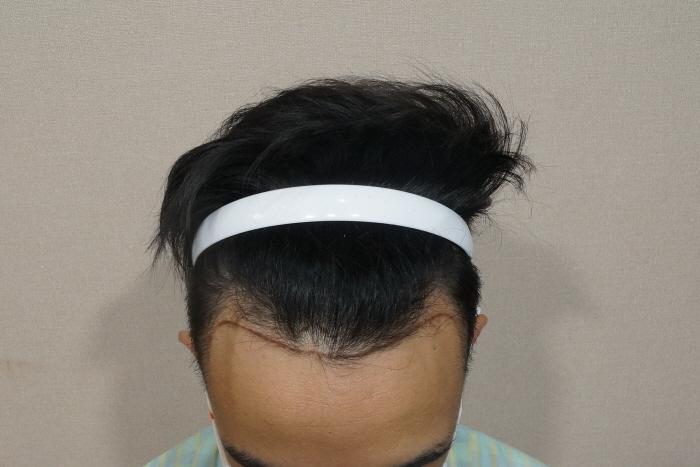 I had 1200 hair follicle M-shaped surgery in Motion.