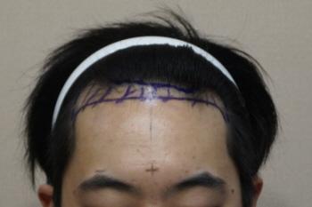 Non-intersecting 2000 hair follicle non-intersecting 9 months