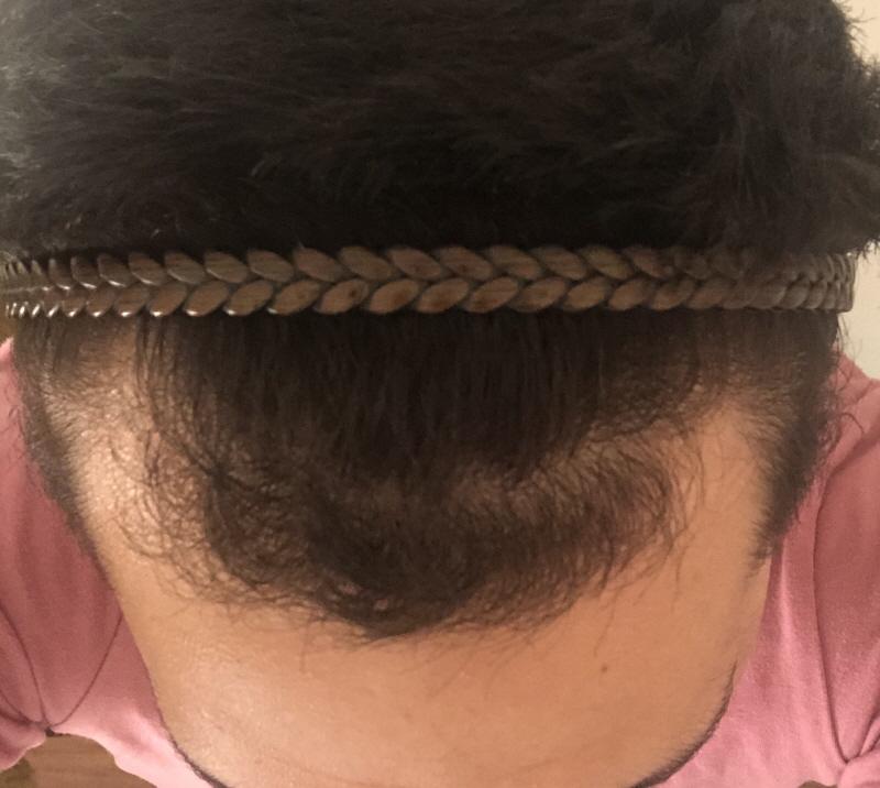 I got a hair transplant for 1100 hair follicle non-excision at Motion.