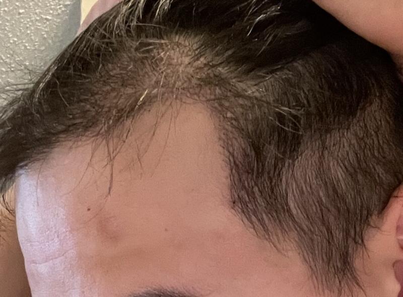 Motion Hair Transplantation Clinic 3,000 Mo 1 Month Later Review