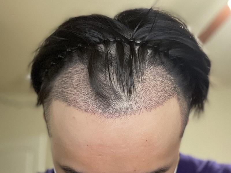 Motion hair transplant clinic 3000 hair removal review.