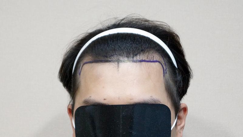 Non-cut 1200 hair follicle hair transplantation 8 months later