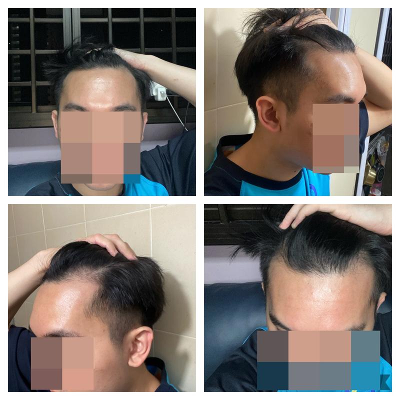 1600모낭 비절개 9개월 경과입니다