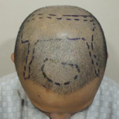 2000 Hair follicle crown density secondary surgery