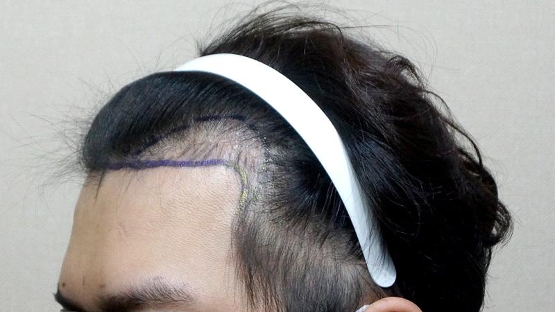 Non-cut 1200 hair follicle hair transplant 10 months later