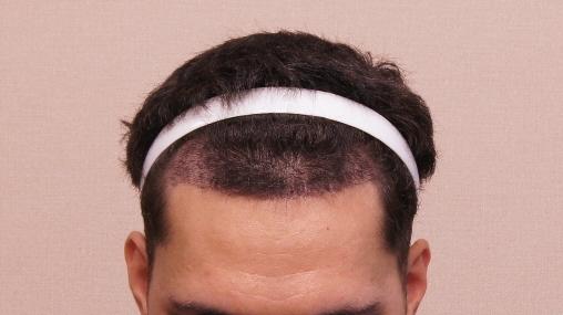Motion 1100 hair follicle non-cut hair transplant and then scabbed.